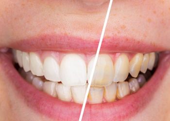 dental scaling