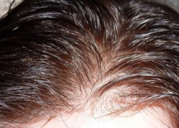 man toupee